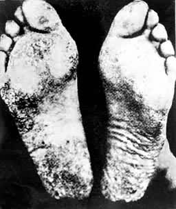 �������ж�����Ľŵ�Ƥ���ǻ�