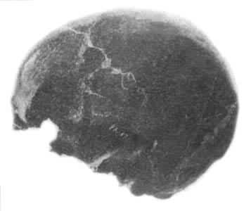 ������ͷ�ǹǻ�ʯ