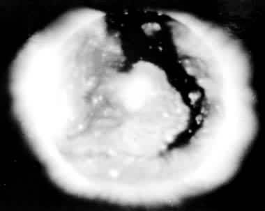 ͼ3 X�����ᶴ