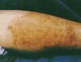 �Ӵ���Ƥ��