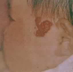 ��÷״Ѫ����