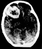 ͼ1 ��Ҷ����ϸ���� CT��Ӱ��ǿɨ�裬�׿��в�����ǿ����������ʾ��Ϊ���