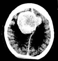 ͼ2 ��Ҷ��Ĥ�� CT��Ӱ��ǿɨ�裬�ɼ�����ǿ�����׿���������������߽��������Χ����ˮ�ף�������ѹ