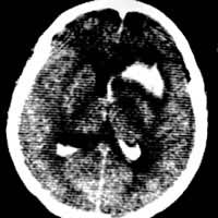 ͼ3 �Գ�Ѫ CTƽɨ�����׽����߶Ȳ��䣬Ѫ����������