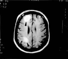 ͼ5 MRI�� ��Ҷ������Ҷ�Գ�Ѫ �����T1�񣬿ɼ���Ҷ������Ҷ���ڸ��źŲ���(��)���߽����