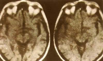 ��Ĥ����MRI-T1��