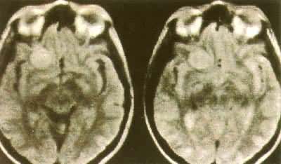 ��Ĥ����MRI-T2��