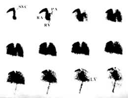 ͼ1 �״�ͨ�������Ժ�����Ѫ����Ӱ����������SVC��ǻ���� RA���ķ� RV������ LV������ PA�ζ���