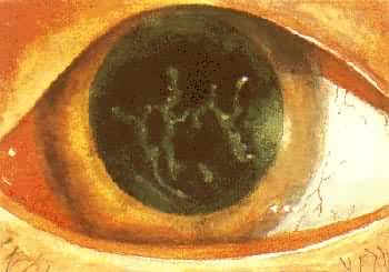 ��Ĥ������֦״��