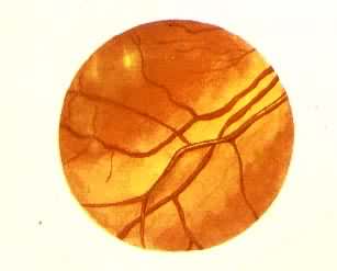 ��Ѫѹ������������֢��